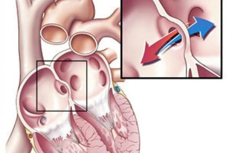 Окно в сердце у ребенка. Незаращение овального окна у детей. Врожденный порок сердца открытое овальное окно. ВПС открытое овальное окно. Открытое овальное окно в сердце у новорожденного.