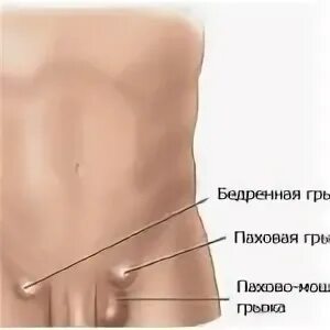 Как отличить паховую. Как отличить паховую