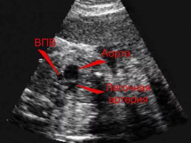 транспозиция магистральных артерий у новорожденных. эхокг при тетрада фалло. срез через 3. срез через 3. срез через 3 сосуда у плода.