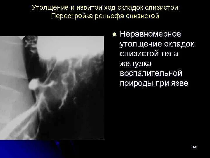 Утолщение складок желудка рентген. "Складки слизистой желудка утолщены, извитые.". Складки слизистой желудка рентген. Утолщены складки желудка на рентгене.