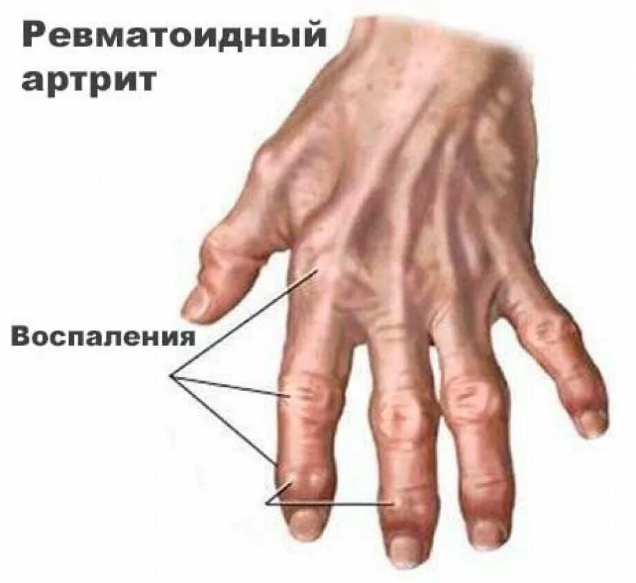 Узелки гебердена и бушара характерны для. Узелки гебердена ревматоидный артрит. Узелки гебердена и бушара. Узелки на нитке на запястье. Гигрома запястья (лучезапястного сустава).