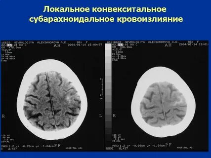 Неравномерно выраженные субарахноидальные пространства