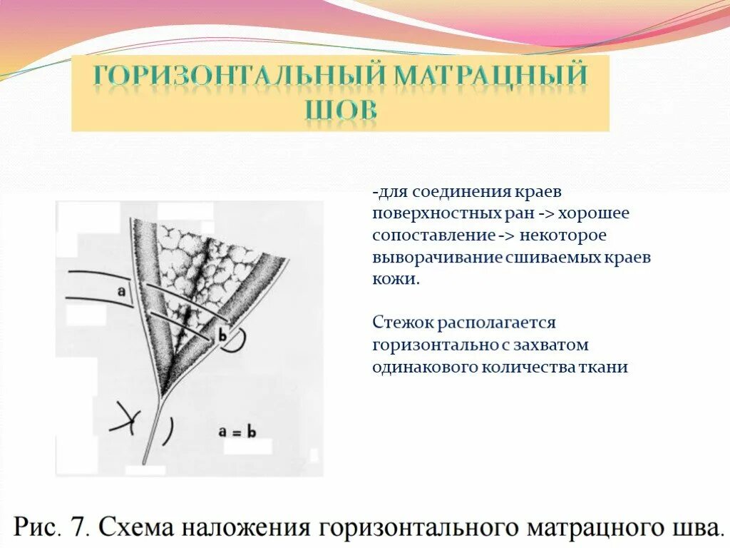 Матрацный шов в хирургии. Непрерывный горизонтальный матрацный шов. горизонтальный и вертикальный матрацный шов. непрерывный матрацный шов в хирургии. горизонтальный матрацный (п-образный) шов.