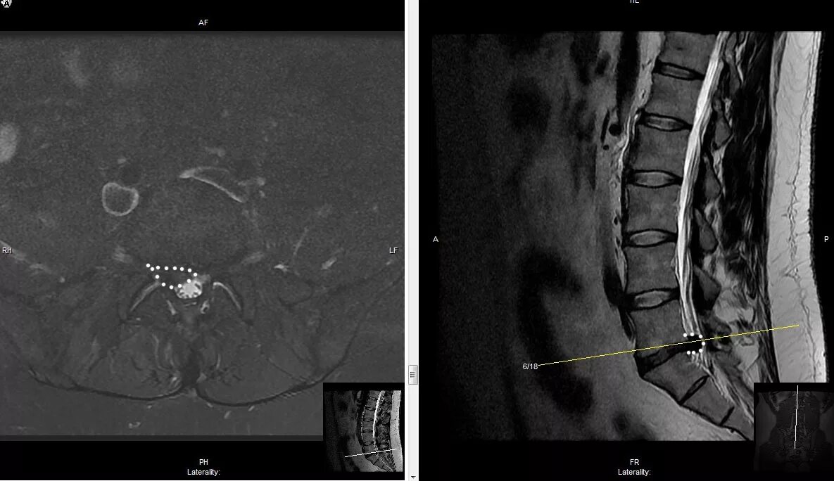 Дегенеративные изменения диска l5. Межпозвонковые диски дегидратированы что это. L5 s1 диск тухумдонга тасири. Дегенеративные изменения диска l5. Дегенеративные изменения диска l5.