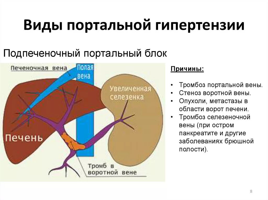 Подпеченочная портальная гипертензия. Портальная гипертензия подпеченочный блок. Портальная гипертензия печеночная подпеченочная. Тромбоз воротной вены на УЗИ. Тромбоз вены печени