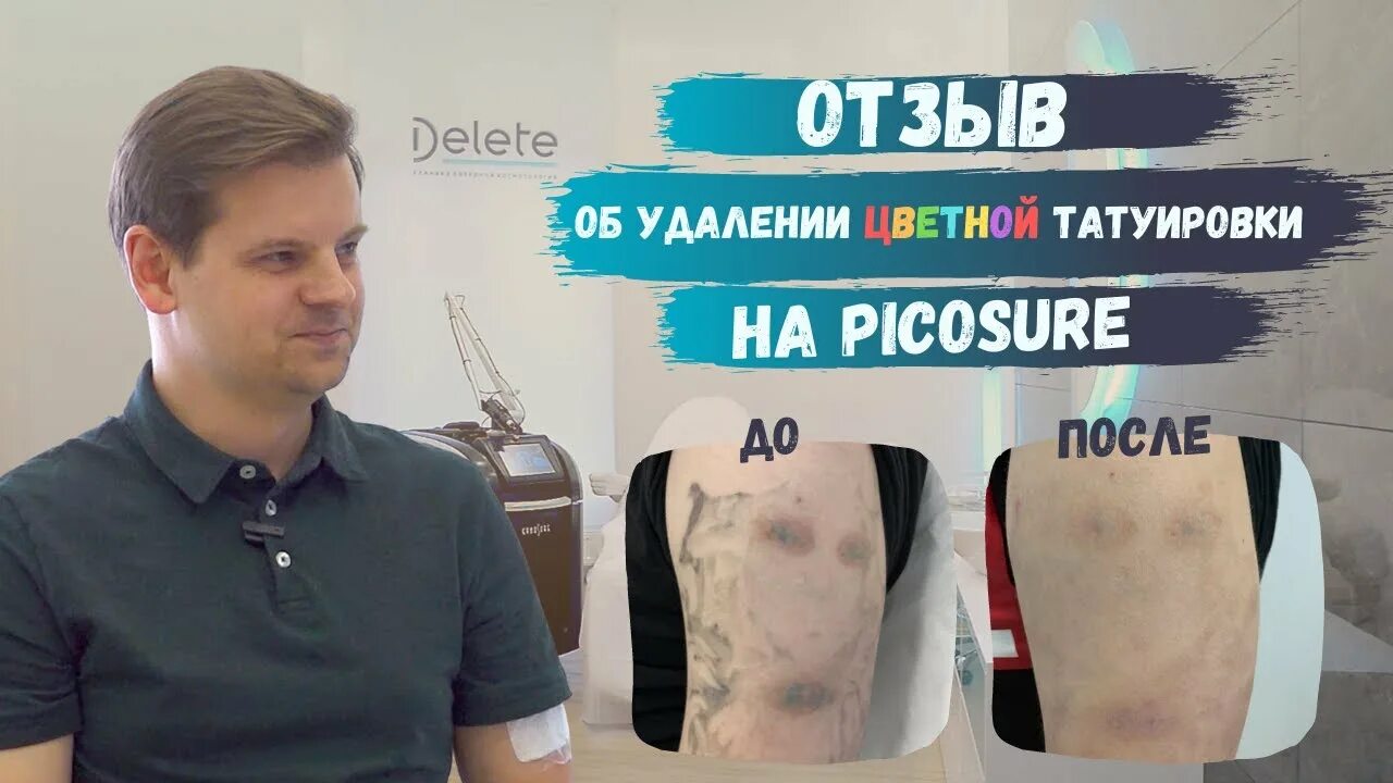 Отзыв тата. Удаление цветного тату пикосекундным лазером. пикосекундный лазер. осветление тату. делет клиник удаление тату. осветление татуировки picosure отзывы.