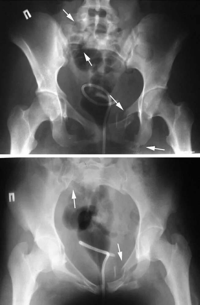 Вертикальный перелом крестца рентген. Поперечный перелом крестца s4. Трансфораминальный перелом крестца.