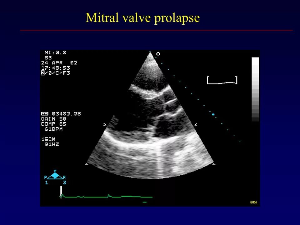 Что такое пролапс митрального клапана. Пролапс митрального клапана степени по УЗИ. Пролапс створки митрального клапана. Пролапс митрального клапана УЗИ. Пролапс митрального клапана на ЭХОКГ.