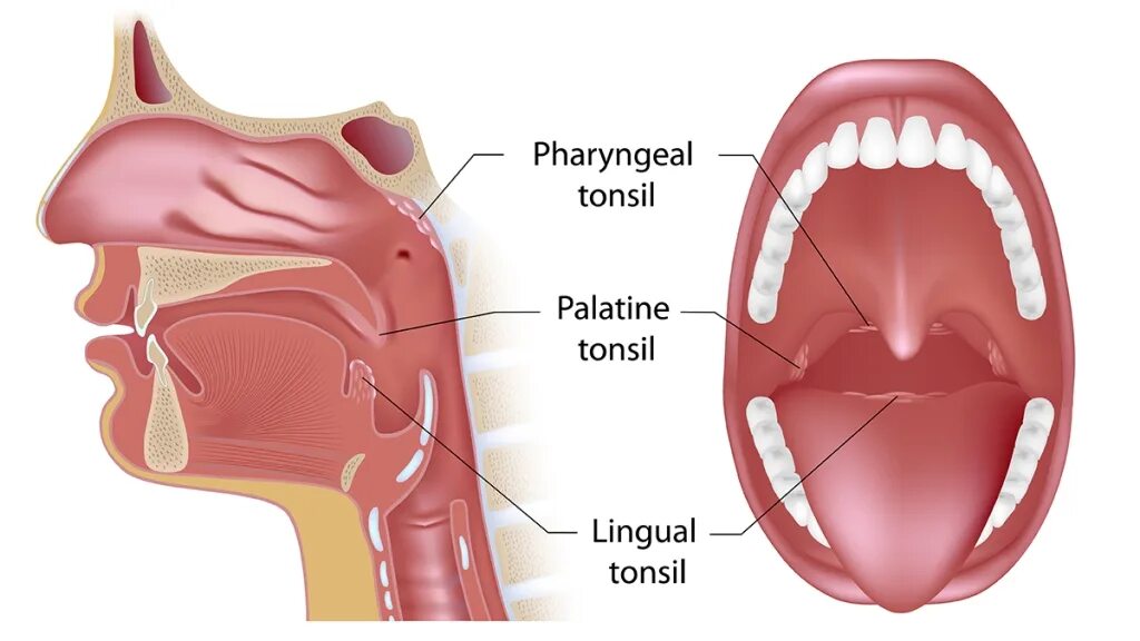 Отросток в гортани lingual Tansil. Lingual Tonsil торчит.