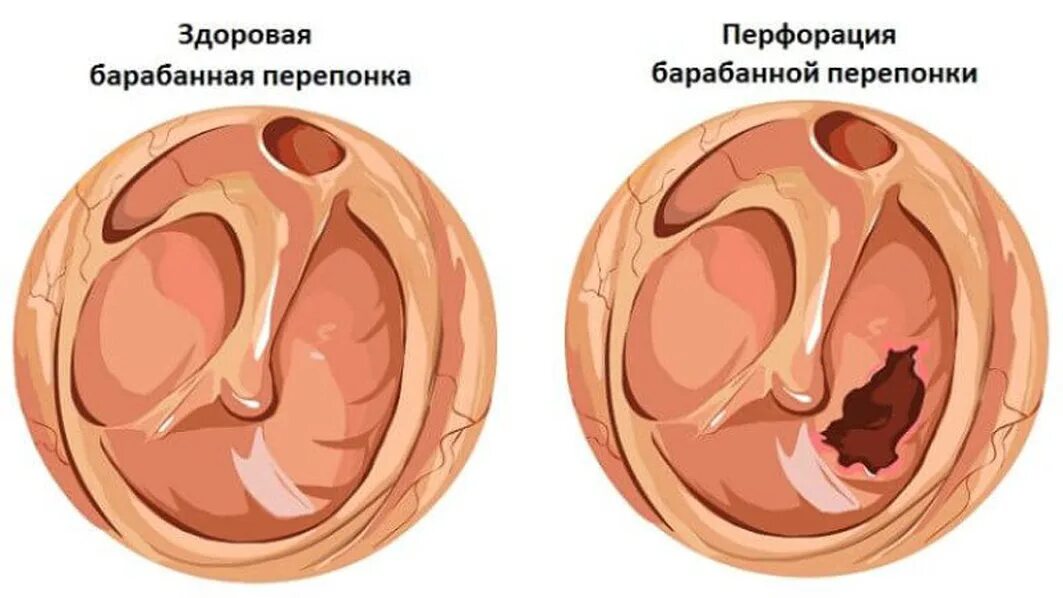 Поврежденная барабанная перепонка. Порванная барабанная перепонка. Отит разрыв барабанной перепонки. Пробивка барабанной перепонки. Наличие барабанной перепонки