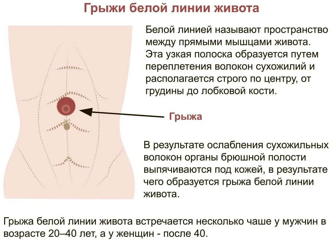 Как болит грыжа. Грыжа белой линии живота анатомические предпосылки. подпупочная грыжа белой линии живота. гоыжа белой линиижиаота. грыжа белой линии живота причины.