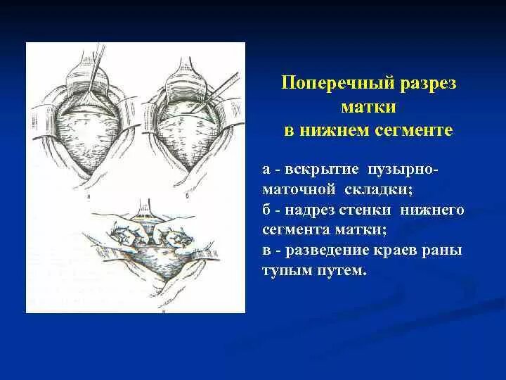 Техника кесарева. Корпоральное кесарево сечение разрез. Корпоральное кесарево сечение техника выполнения. Поперечный кесарево поперечный разрез. Ретровезикальное кесарево сечение.