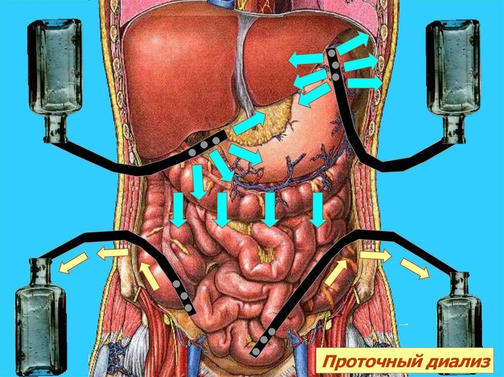 Лечение после перитонита. Острый перитонит брюшной полости. Диализ брюшной полости перитонеальный. Проточный перитонеальный диализ. Перитонит дренирование брюшной полости.