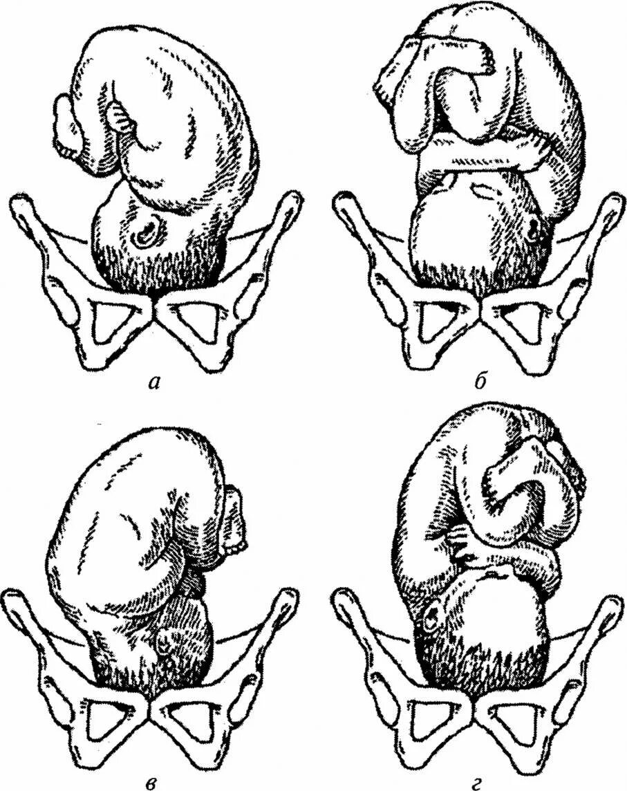 Задний вид затылочного предлежания плода. Задний вид затылочного предлежания биомеханизм родов. Продольное головное предлежание плода. Затылочное предлежание плода механизм родов. 36 недель тазовое