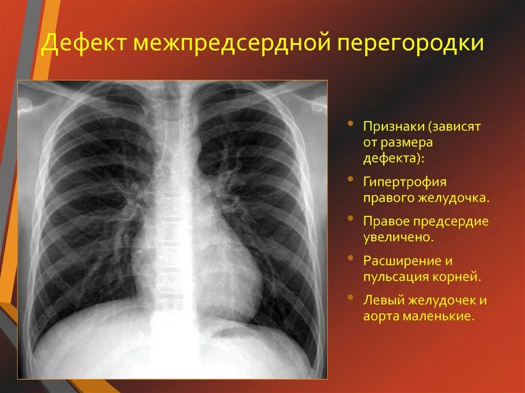 Дефект аортолегочной перегородки тест. Дефект межпредсердной перегородки рентген.