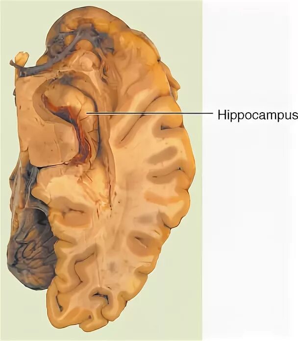 Повреждение гиппокампа. Гиппокамп анатомия. Гиппокамп анатомия препарат. Гиппокамп на препарате мозга. Hippocampus на препарате.