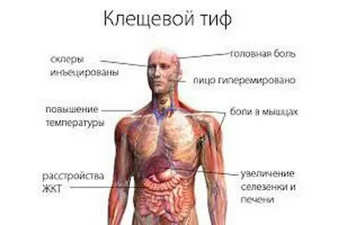 Признаки сыпного тифа