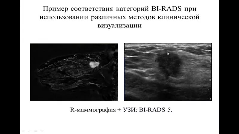 Bi rads молочной железы классификация УЗИ. Бирадс УЗИ молочной железы. Маммография бирадс. Классификация bi rads при УЗИ молочных.