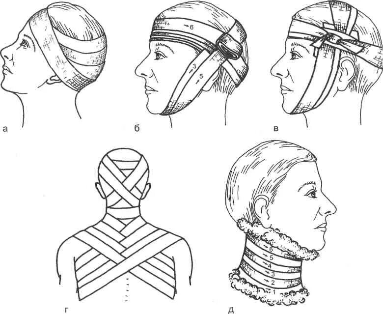 Техника наложения восьмиобразной повязки на затылочную область. Крестообразная повязка на затылочную на затылок и шею. Десмургия крестообразная повязка. Десмургия восьмиобразная повязка. Наложение крестообразной повязки на затылок алгоритм.