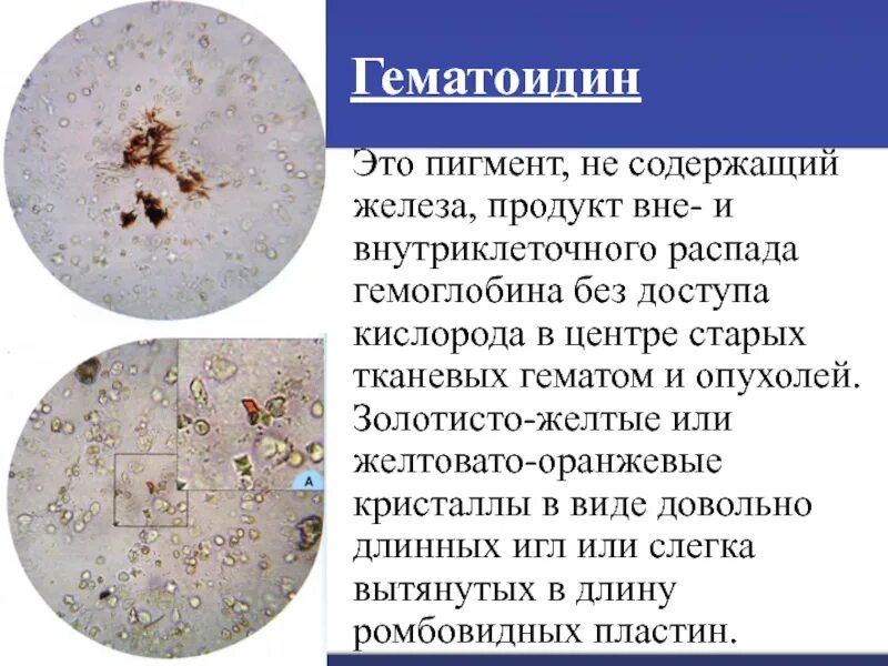 Микроскопия мокроты Кристаллы гематоидина. Микроскопия кала гематоидина. Микроскопия мокроты Кристаллы гемосидерина.