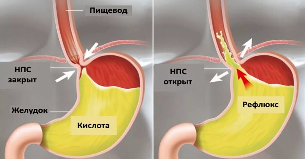 Сфинктер желудка и пищевода. КЛАМАН меж желудком и пищеводом. Средство от рефлюкса