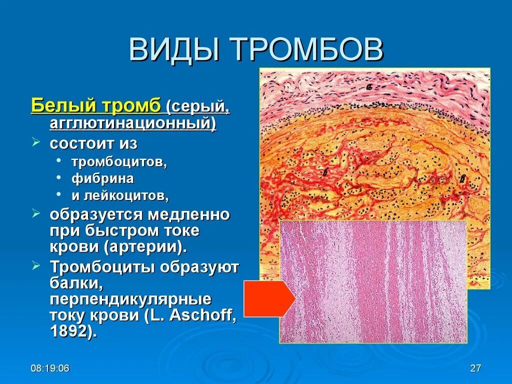 Смешанный тромб строение. Строение смешанного тромба. Строение красного тромба. Организация тромба