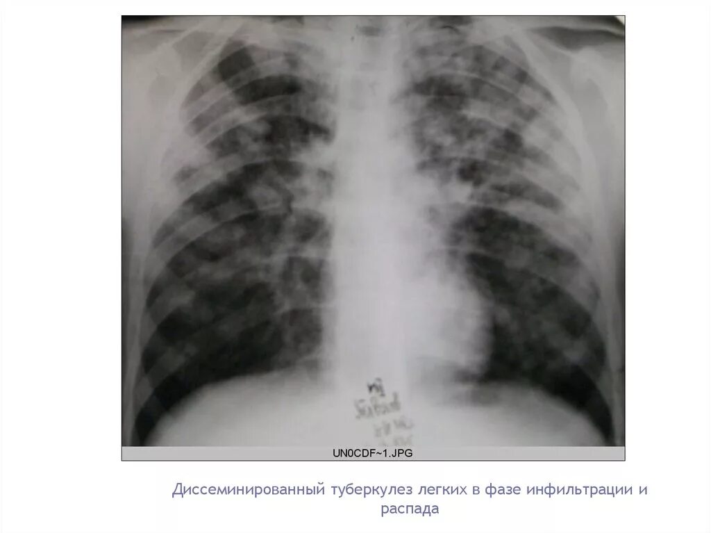 Инфильтративный легкого в фазе распада. Диссеминированный туберкулез в фазе инфильтрации. Диссеминированный туберкулез в фазе инфильтрации рентгенограмма. Милиарный диссеминированный туберкулез рентген. Диссеминированный туберкулез легких в фазе инфильтрации.