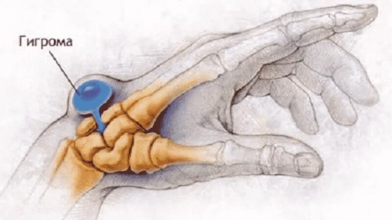 Гигрома лучезапястного сустава кисти. Гигрома (ганглий) лучезапястного сустава.