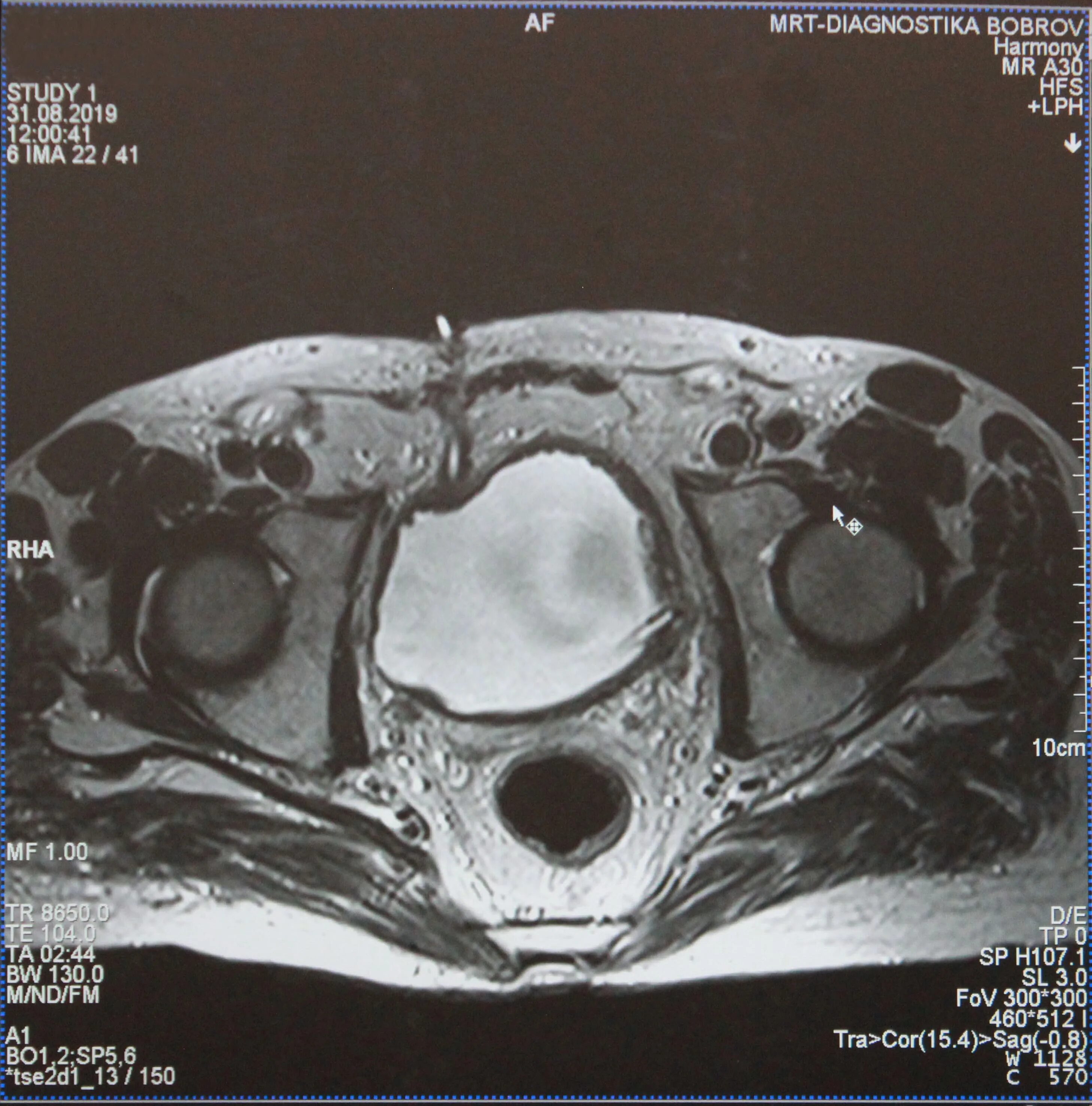 мрт малого таза сергея березина. зубчатая линия на мрт малого таза. мрт малый таз. мрт таза пермь. лимфоцеле мрт малый таз.