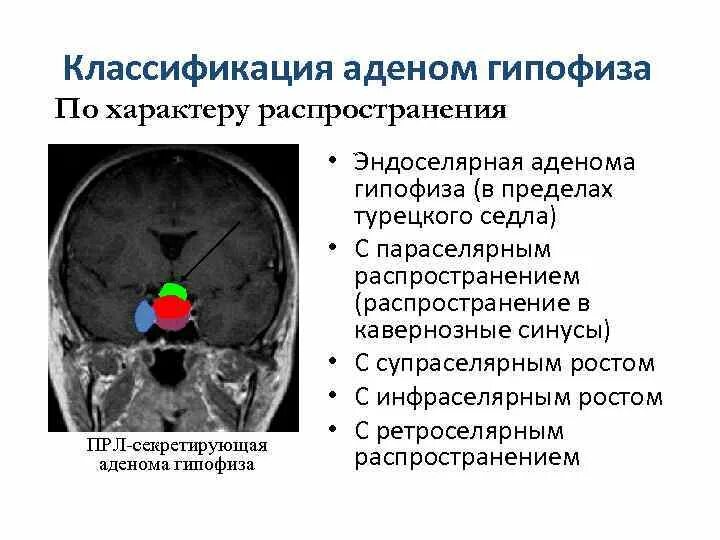 Виды гипофиза. Супраселлярная аденома гипофиза мрт. Эндоселлярная аденома. Инфраселлярный рост аденомы гипофиза. Новообразования гипофиза кт.