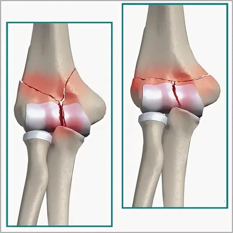 Локтевого мыщелка. Перелом мыщелка локтевого сустава. Мыщелковый перелом локтевого сустава. Чрезмыщелковый перелом плеча. Перелом плечевой кости в локтевом суставе.