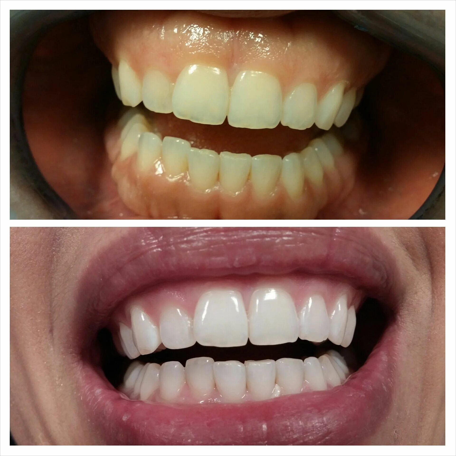 Лазерное отбеливание отзывы. Отбеливание Dental отбеливание Discus. Отбеливание Beyond Polus before after. Фотоотбеливание зубов до и после.