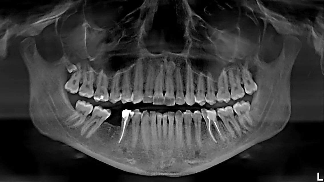 Кт нижней челюсти цена в ульяновске. Ортопантомограмма (ОПГ). Панорамный снимок ОПТГ. ОПТГ зубных рядов Пикассо.