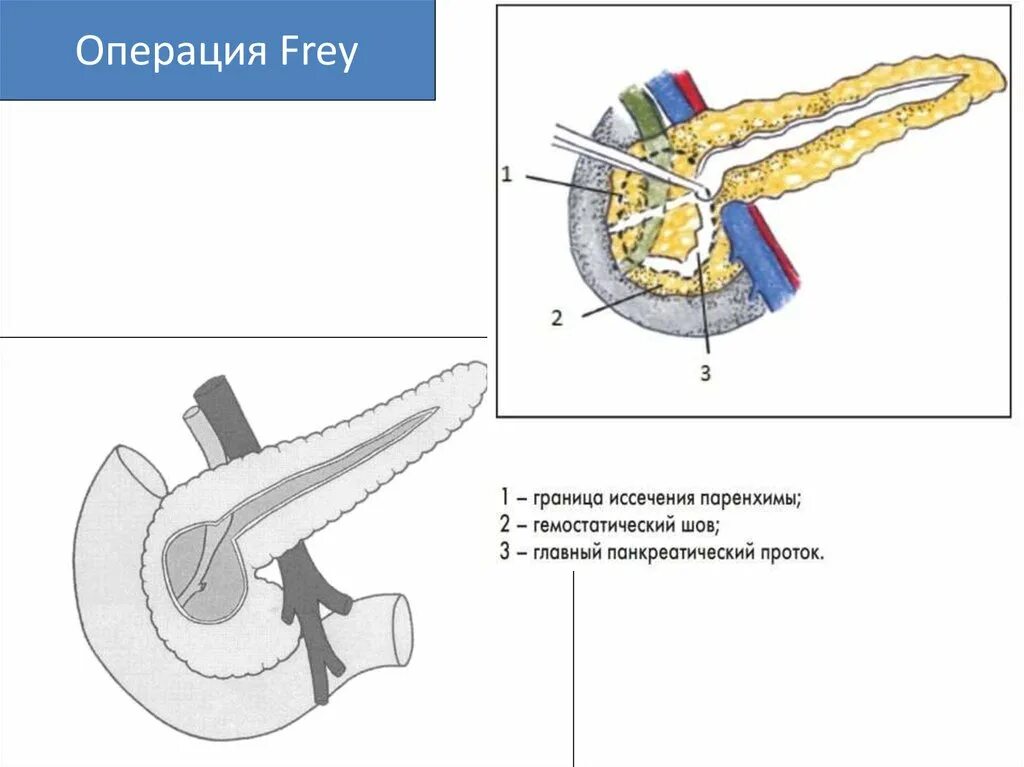 Операция Бегера на поджелудочной железе схема. Операция Фрея Бернский вариант. Операция Бегера Бернский вариант. Панкреатит операцию делают