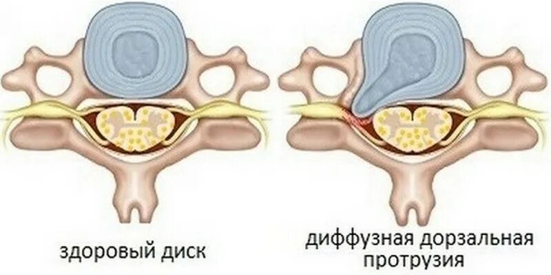 Протрузия что это такое и как. Циркулярная протрузия межпозвонкового диска l3-l4. циркулярная грыжа межпозвонкового диска. диффузная дорзальная грыжа межпозвонкового диска l4-l5. фораминальная грыжа межпозвоночного диска.