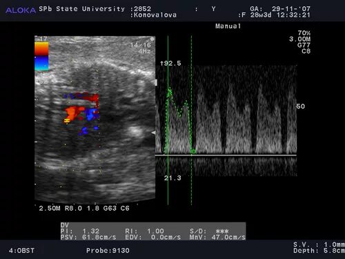 реверсный кровоток в венозном протоке у плода 12 недель. венозный проток реверсный кровоток. маркеры хромосомной патологии плода расшифровка. венозный проток реверсный кровоток. кровоток в венозном протоке у плода норма 12.