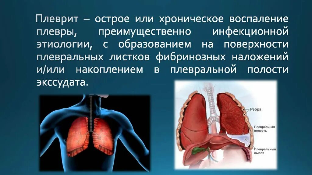 Плеврит это. Плеврит это