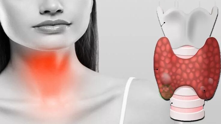 Parathyroid Cancer Treatment - NCI