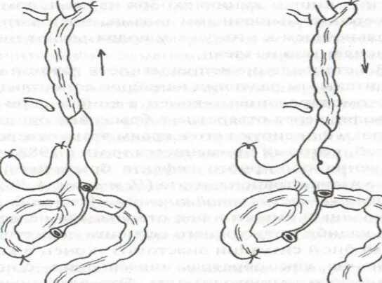 Гастрэктомия анастомоз. Анастомоз по ру при гастрэктомии. Пищеводно-кишечный анастомоз. Обходной анастомоз желудка по ру. Анастомоз пищевода