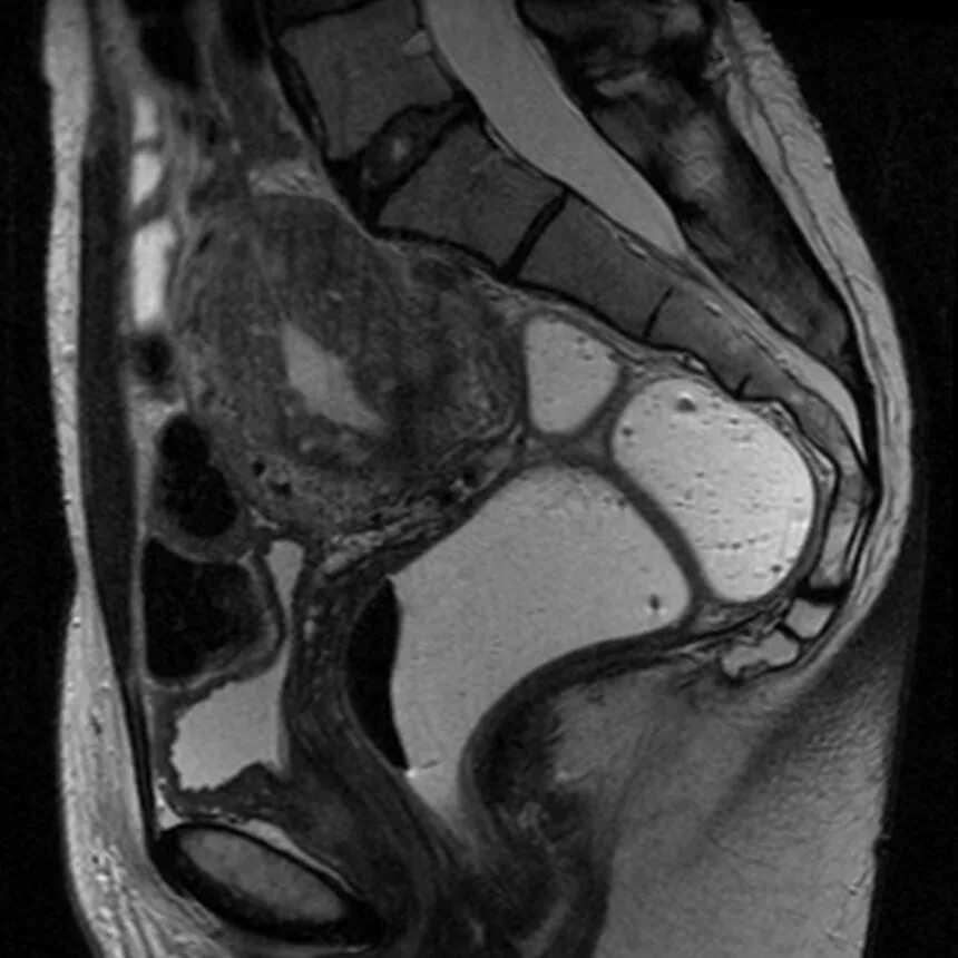 Ретроцервикальный эндометриоз мрт. Эндометриоз яичника мрт. Эндометриома матки мрт. Ретроцервикальный аденомиоз мрт. Мрт эндометрия