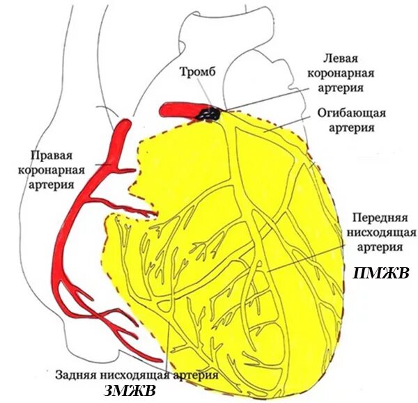 Коронарные артерии сердца схема. Поражение коронарных артерий и локализация инфаркта миокарда. Окклюзия ствола левой коронарной артерии на ЭКГ. Поражение коронарных артерий и локализация инфаркта ЭКГ.