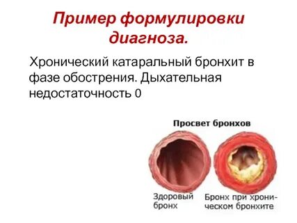Хронический экссудативный бронхит