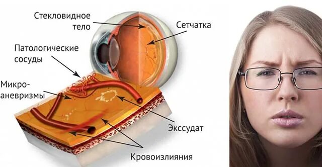 Макулярный отек сетчатки глаза. Стекловидный отек глаз. Кистозный отек в макуле.