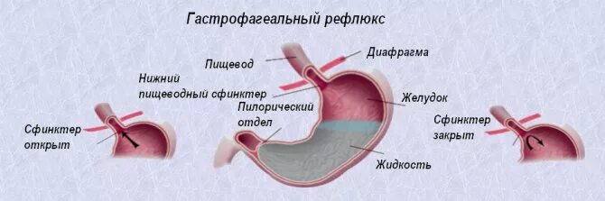 Средство от рефлюкса. Терминальный рефлюкс эзофагит что это. Лекарства при рефлюксе желудка. Лекарство от рефлюкса эзофагита.