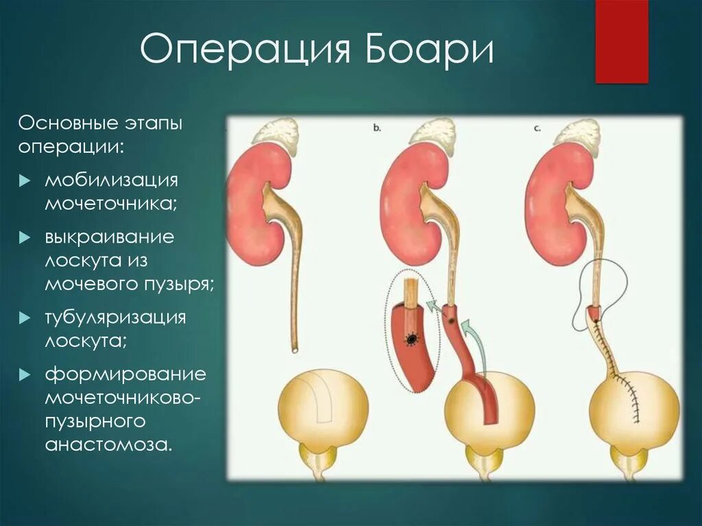 Пузыре или мочеточниках. Пластика мочеточников: операции по Боари. Пластика мочеточника по Боари. Операция гидронефроз мочеточника.