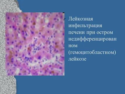 Печень при остром лейкозе