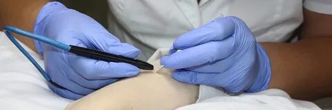 Электроэпиляция ростов на дону