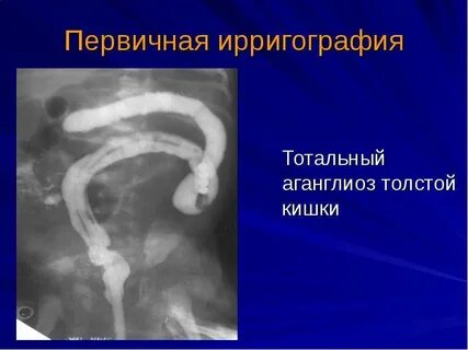 Врожденная высокая кишечная непроходимость