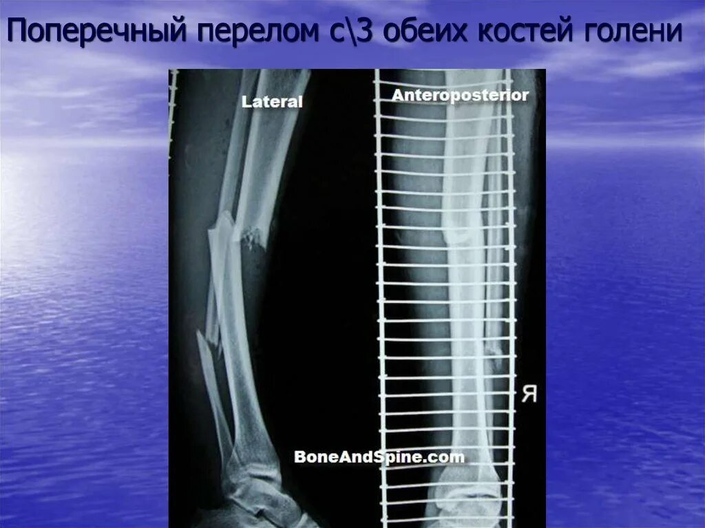 Поперечный перелом голени. Поперечный перелом голени рентген. Перелом обеих костей голени. Рентгеноанатомия костей голени.