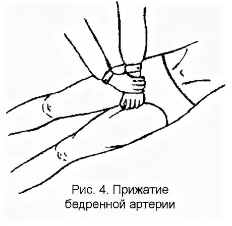 Прижатие бедренной артерии при кровотечении. Способ прижатия бедренной артерии.